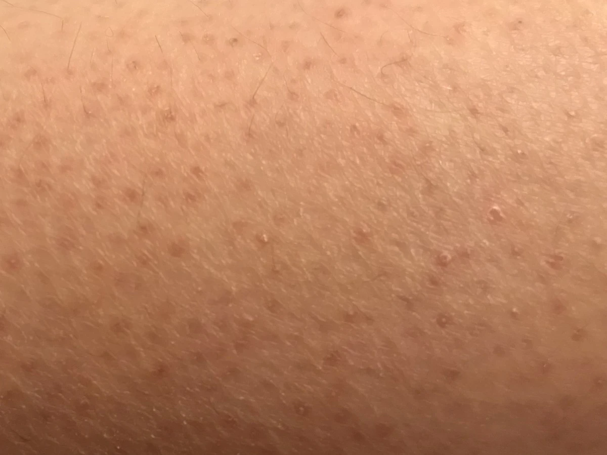 Adiós a la piel de gallina: el truco casero que los dermatólogos aman - image 1